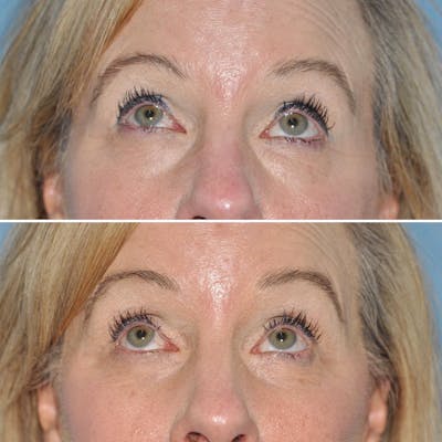Blepharoplasty Before & After Gallery - Patient 144687220 - Image 1