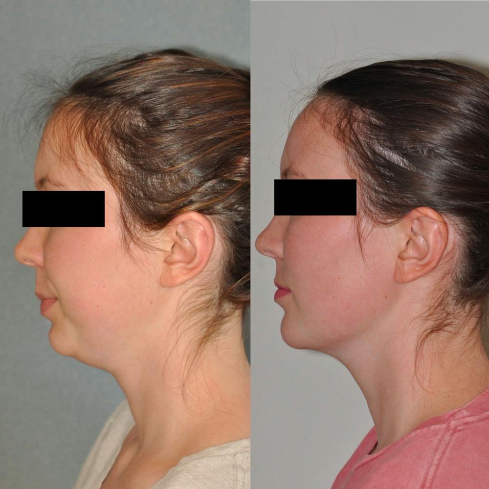 Neck Liposuction Before & After Gallery - Patient 31709172 - Image 1