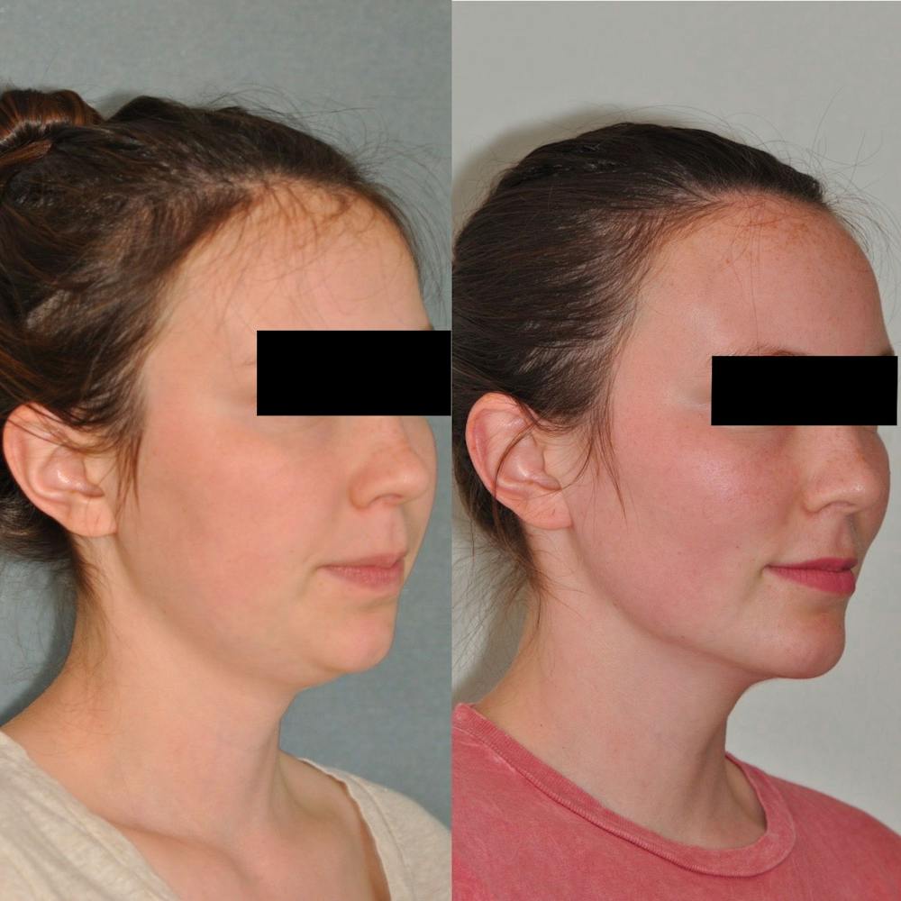 Neck Liposuction Before & After Gallery - Patient 31709172 - Image 2