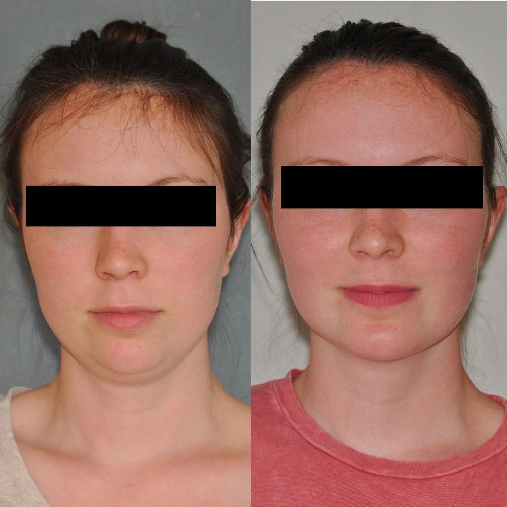 Neck Liposuction Before & After Gallery - Patient 31709172 - Image 4