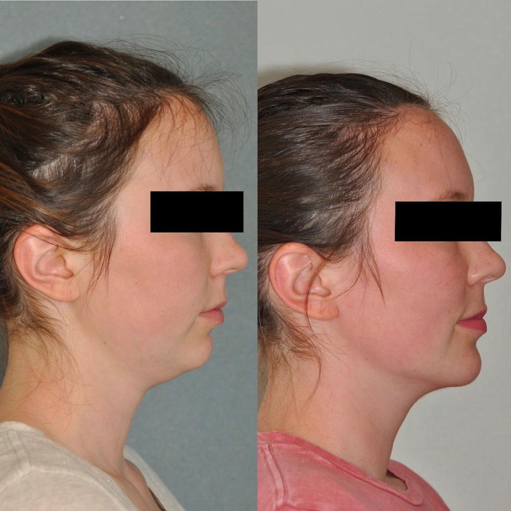Neck Liposuction Before & After Gallery - Patient 31709172 - Image 5