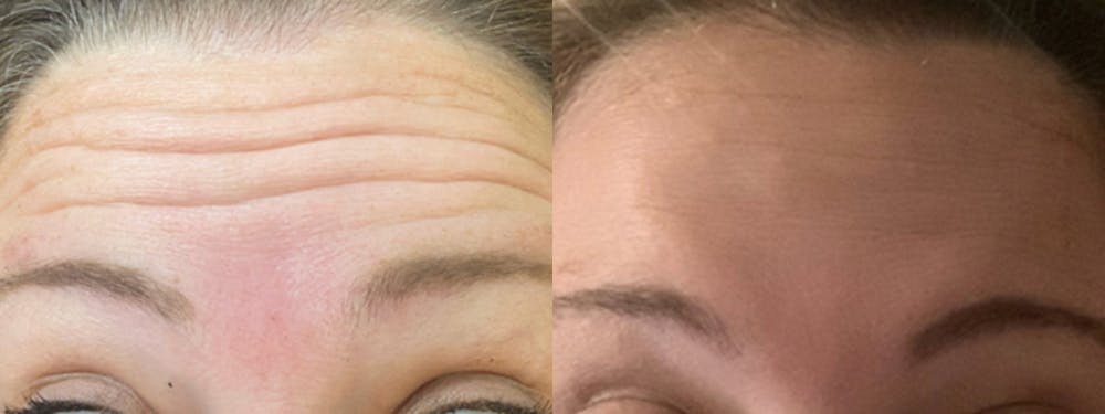 Botox/Dysport Before & After Gallery - Patient 148446629 - Image 1