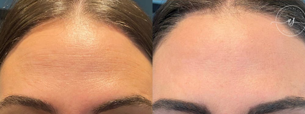 Botox/Dysport Before & After Gallery - Patient 148446631 - Image 1