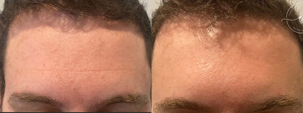 Botox/Dysport Before & After Gallery - Patient 148446632 - Image 2