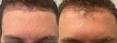 Botox/Dysport Before & After Gallery - Patient 148446632 - Image 2
