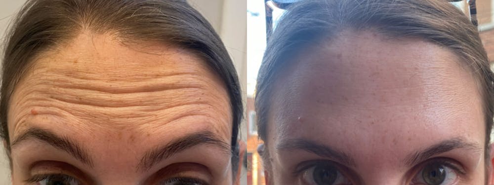 Botox/Dysport Before & After Gallery - Patient 148520465 - Image 1