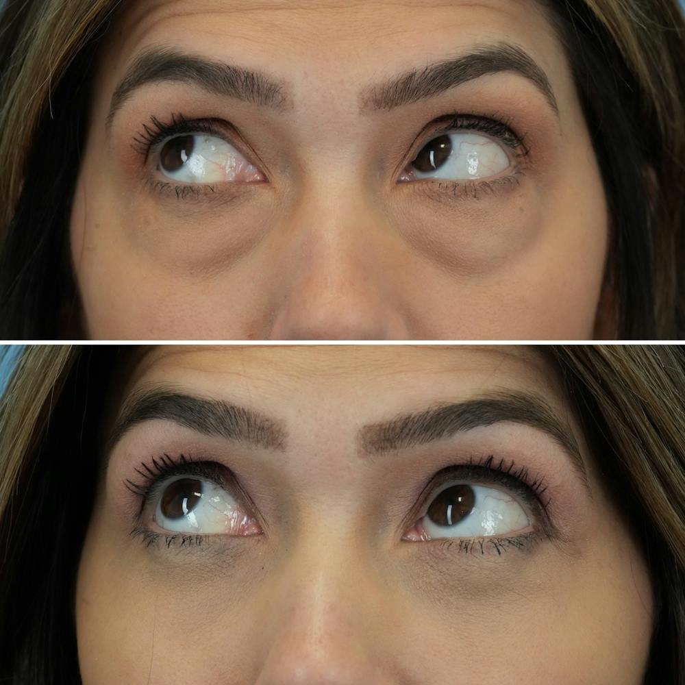 Blepharoplasty Before & After Gallery - Patient 176883543 - Image 4