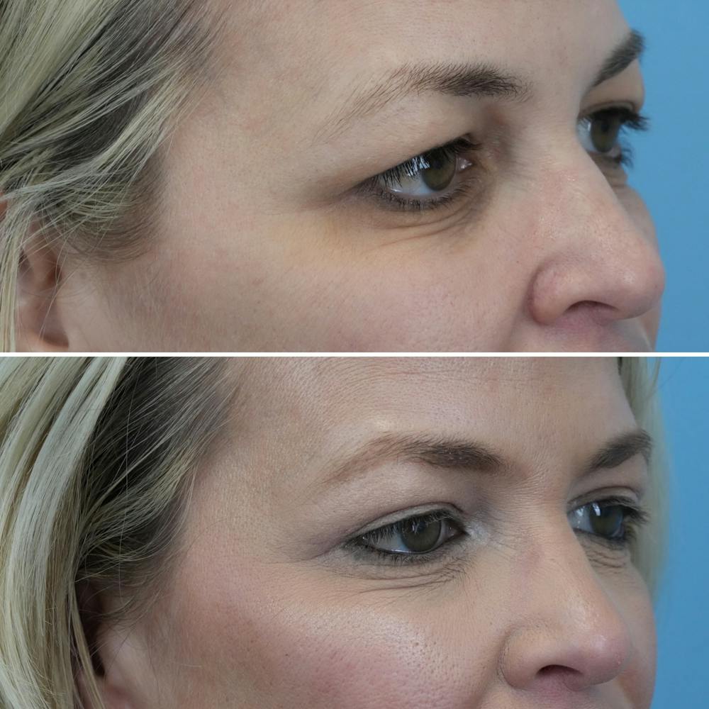 Blepharoplasty Before & After Gallery - Patient 176883544 - Image 2