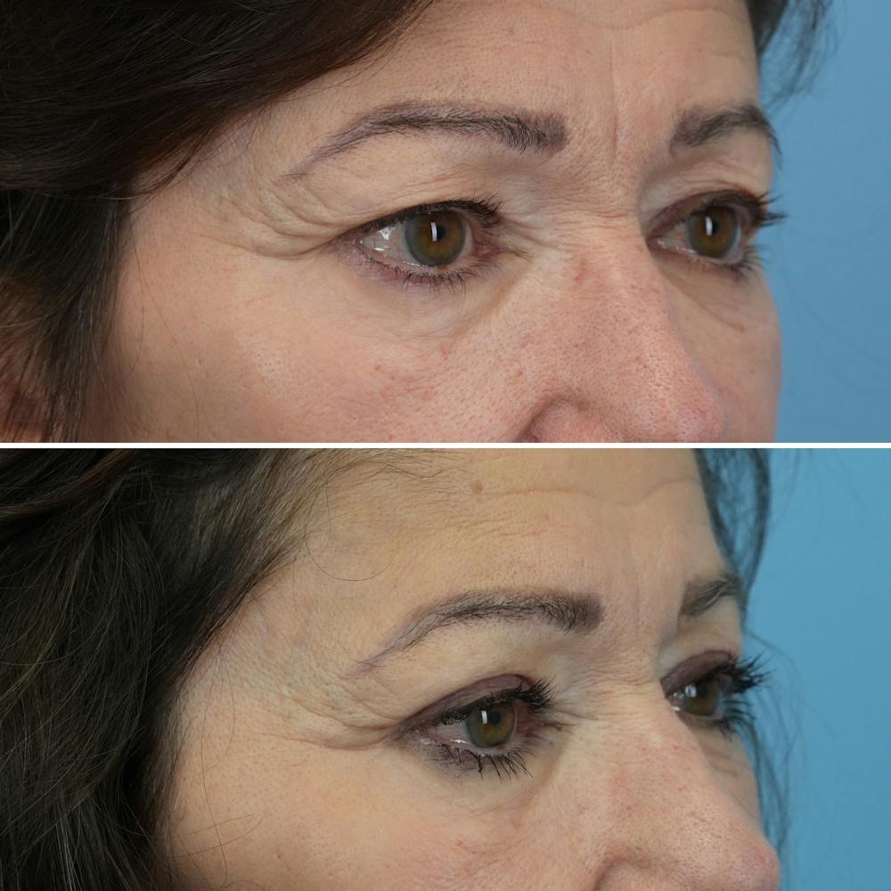 Blepharoplasty Before & After Gallery - Patient 176883567 - Image 2