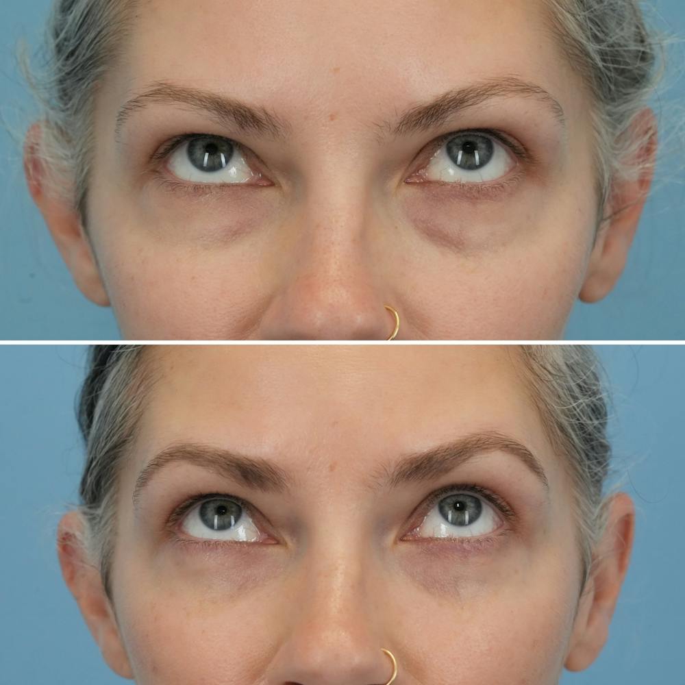 Blepharoplasty Before & After Gallery - Patient 176883545 - Image 1