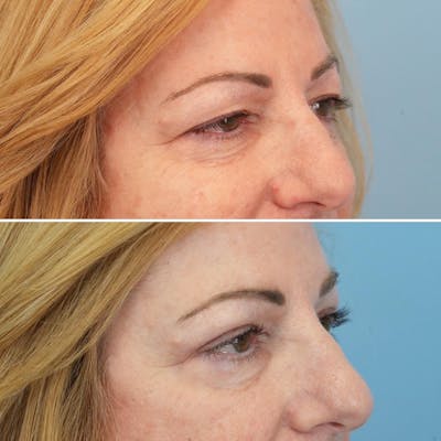 Blepharoplasty Before & After Gallery - Patient 176883566 - Image 2