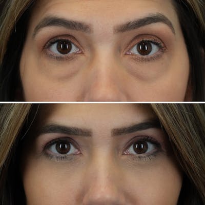 Blepharoplasty Before & After Gallery - Patient 176883543 - Image 2