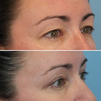 Blepharoplasty Before & After Gallery - Patient 176883565 - Image 2
