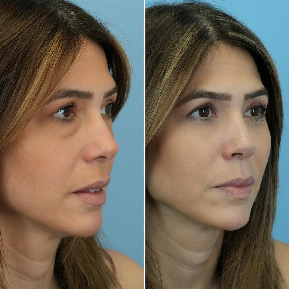 Blepharoplasty Before & After Gallery - Patient 176883543 - Image 7