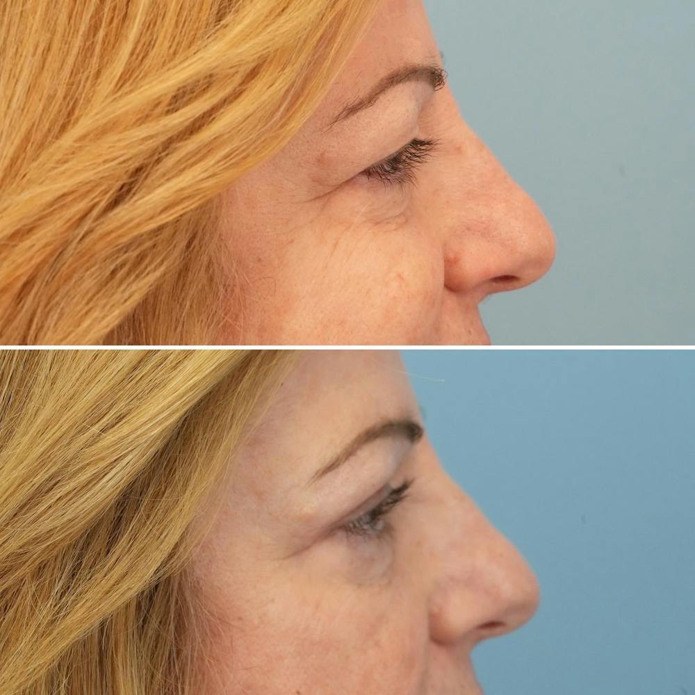 Blepharoplasty Before & After Gallery - Patient 176883566 - Image 3