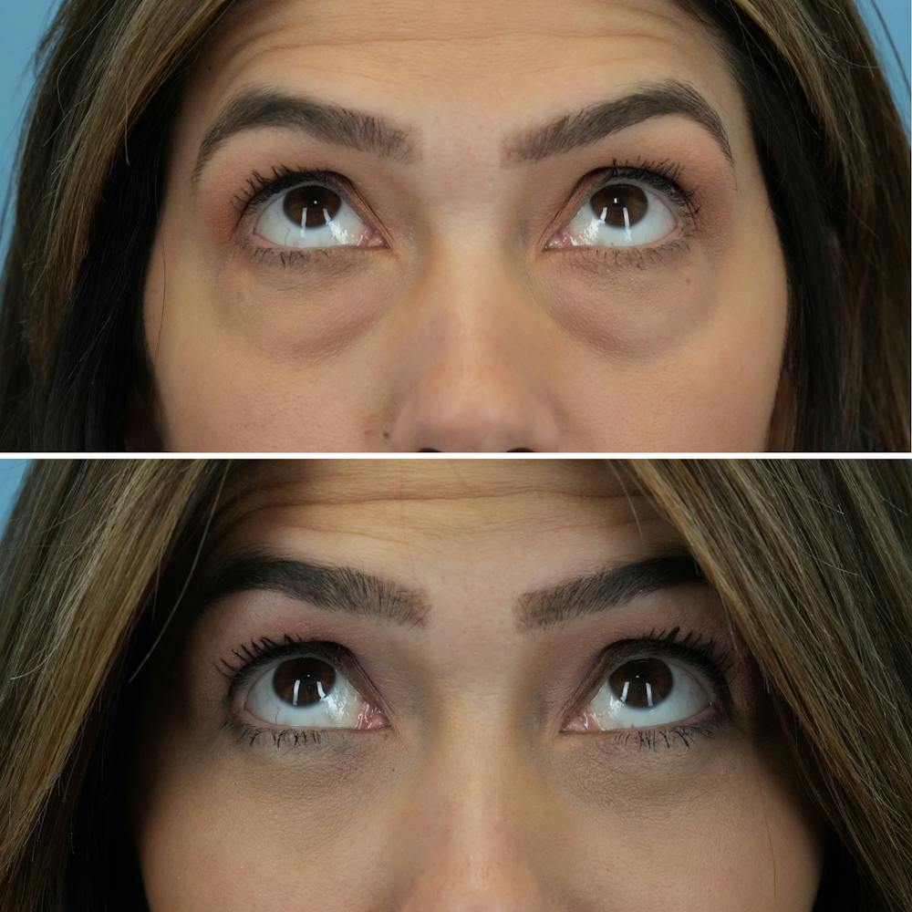 Blepharoplasty Before & After Gallery - Patient 176883543 - Image 3