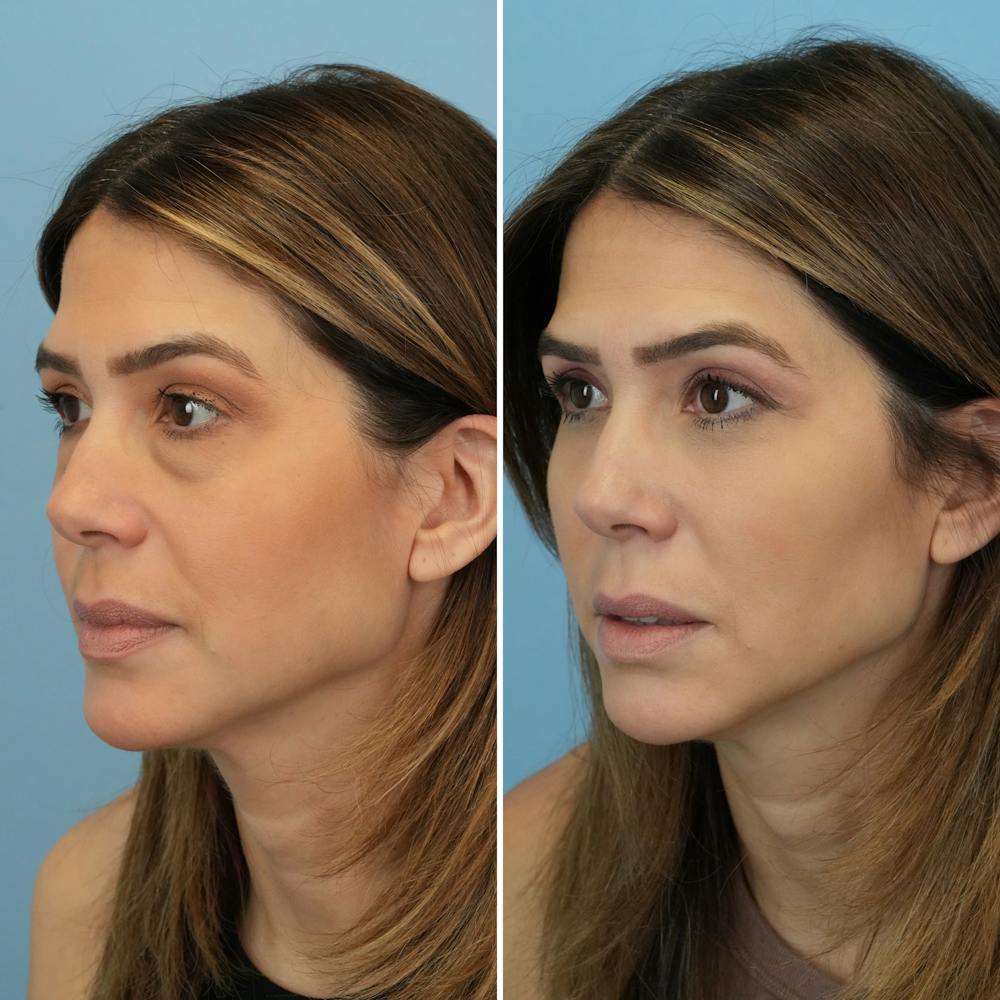 Blepharoplasty Before & After Gallery - Patient 176883543 - Image 8