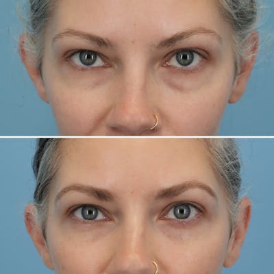 Blepharoplasty Before & After Gallery - Patient 176883545 - Image 2