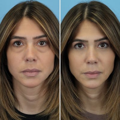 Blepharoplasty Before & After Gallery - Patient 176883543 - Image 6