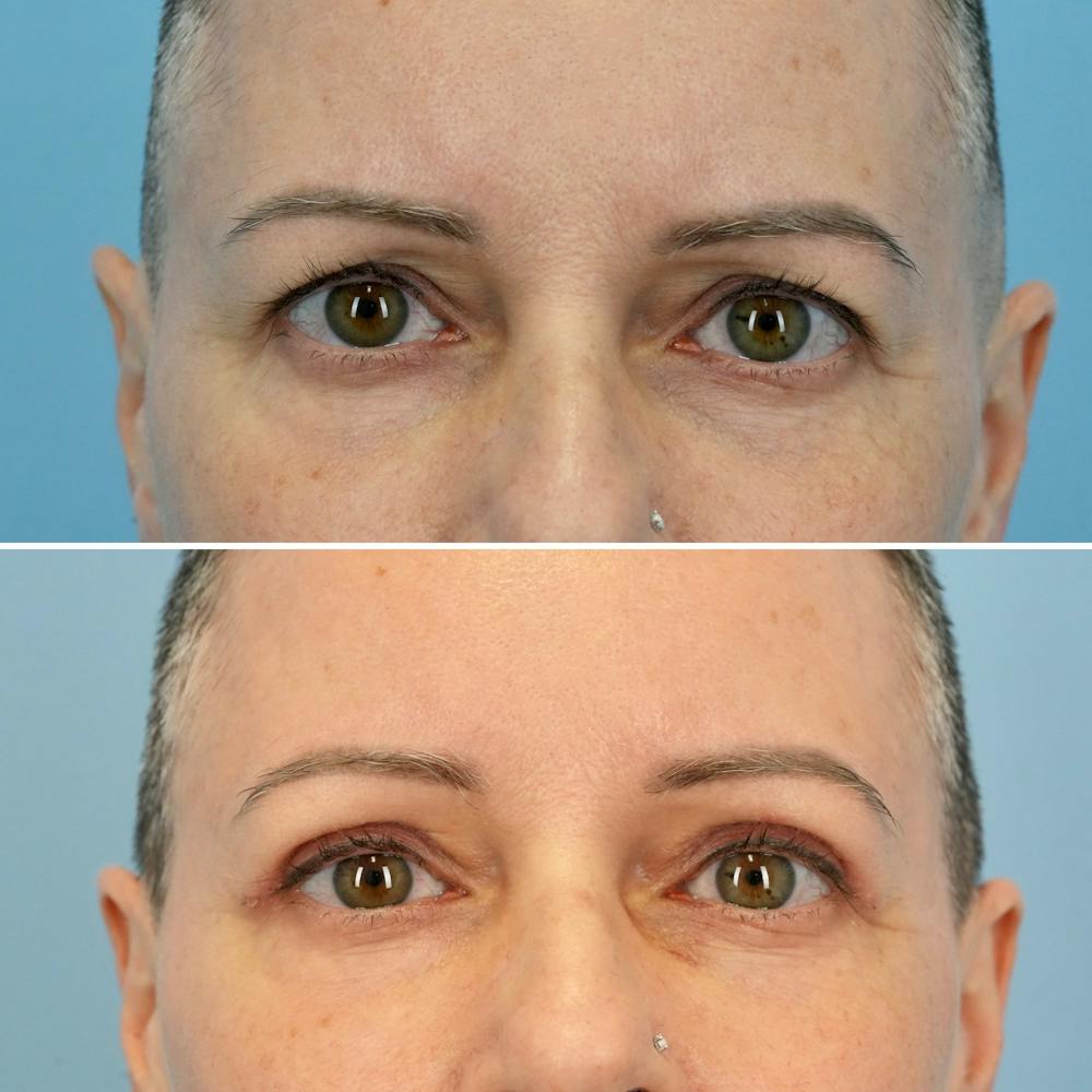 Blepharoplasty Before & After Gallery - Patient 176883568 - Image 1