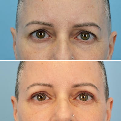 Blepharoplasty Before & After Gallery - Patient 176883568 - Image 1