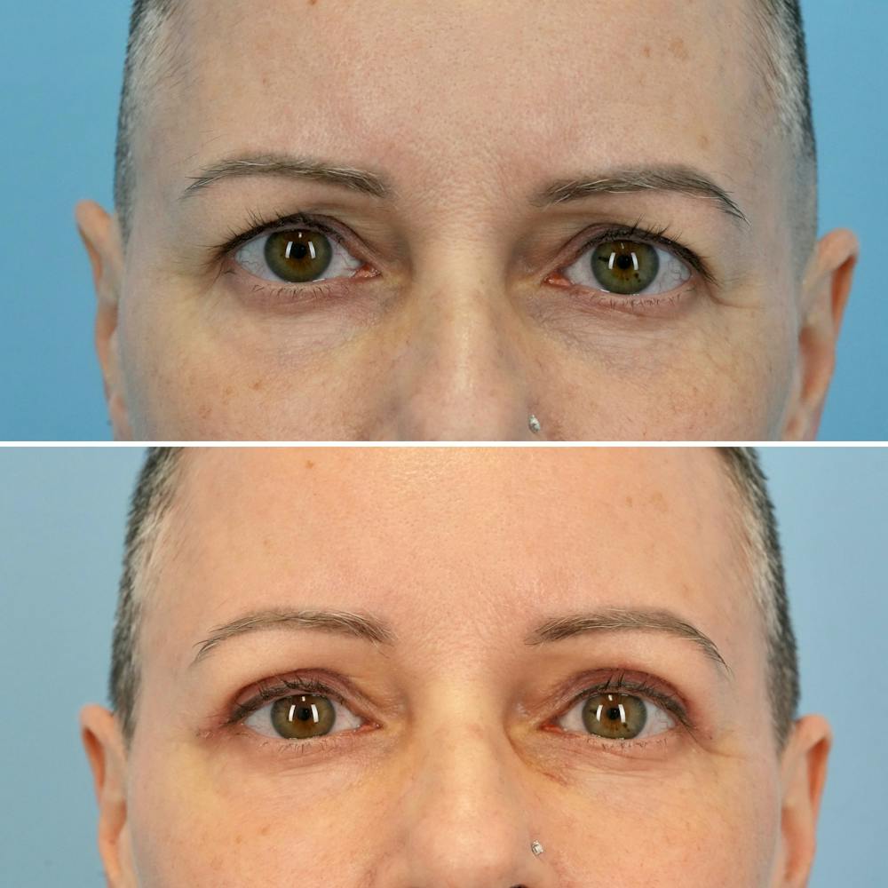 Blepharoplasty Before & After Gallery - Patient 176883568 - Image 1