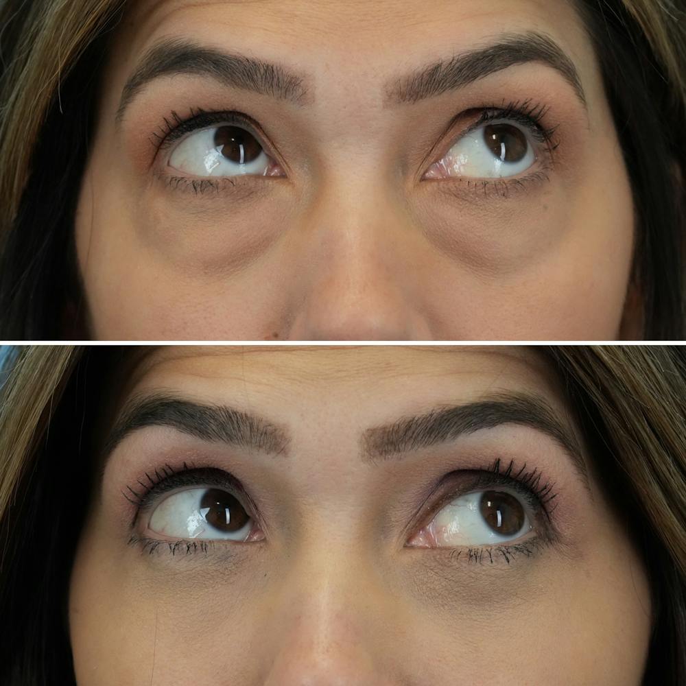 Blepharoplasty Before & After Gallery - Patient 176883543 - Image 5