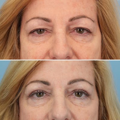 Blepharoplasty Before & After Gallery - Patient 176883566 - Image 1