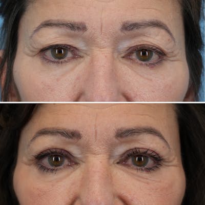 Blepharoplasty Before & After Gallery - Patient 176883567 - Image 1