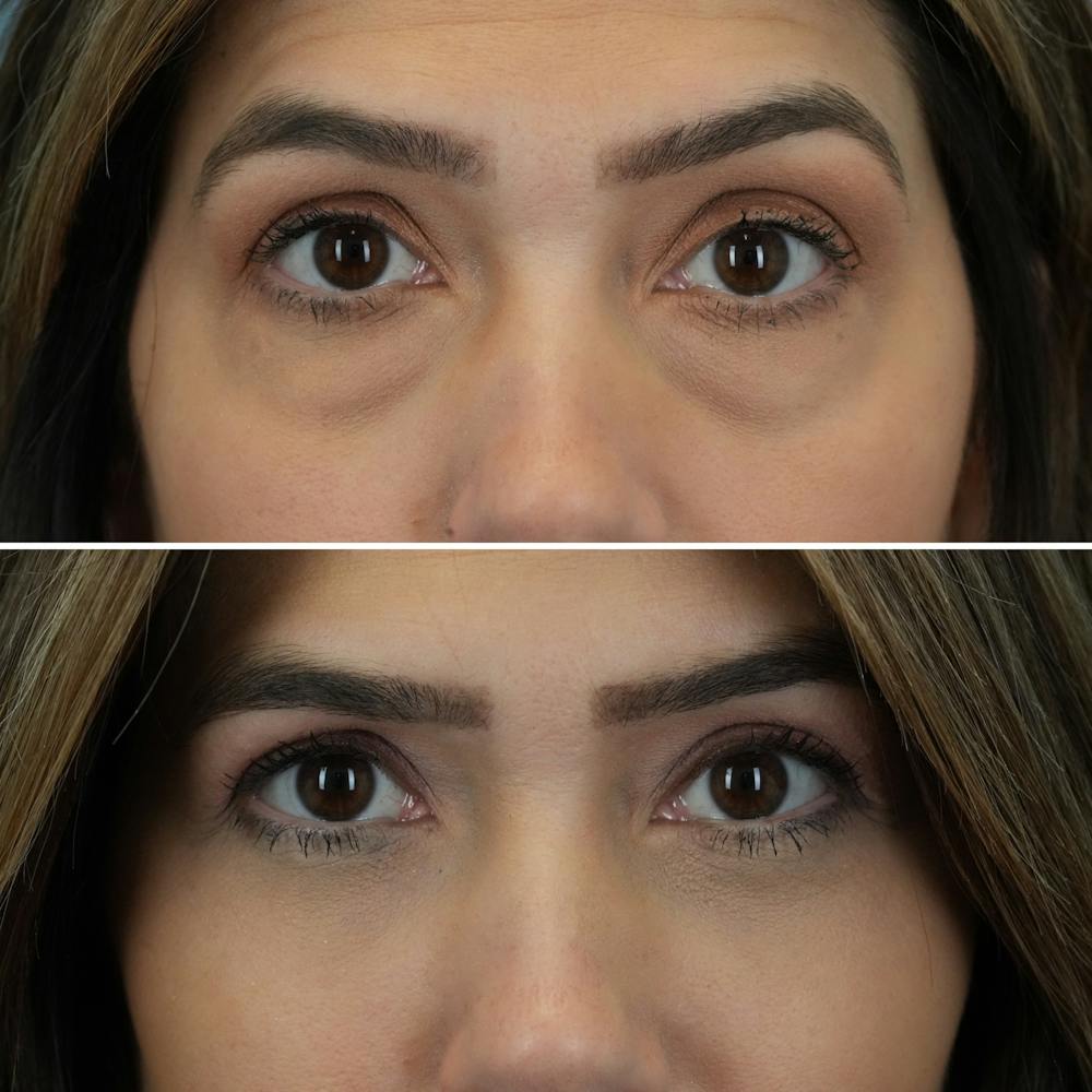 Blepharoplasty Before & After Gallery - Patient 176883543 - Image 1