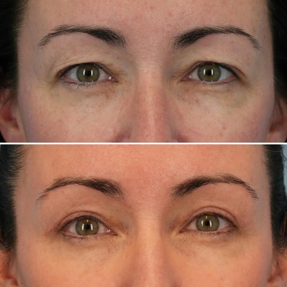 Blepharoplasty Before & After Gallery - Patient 176883565 - Image 1