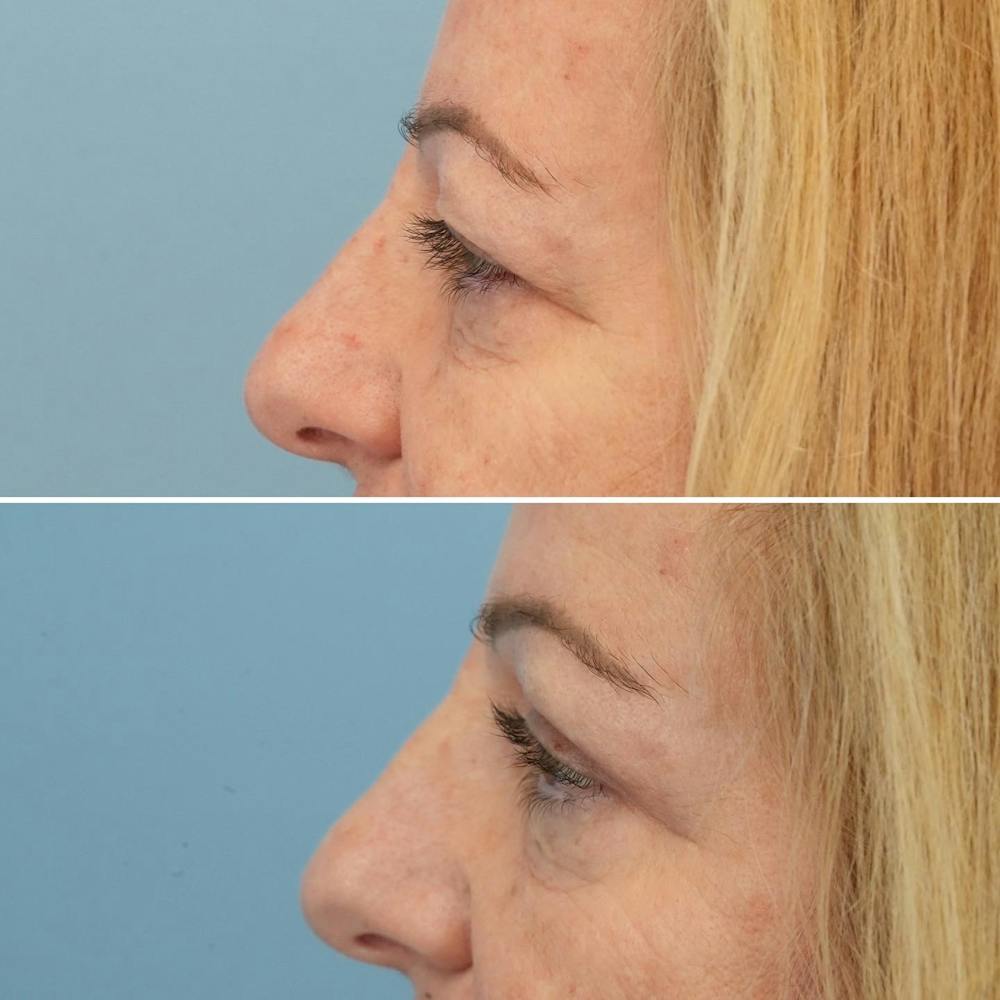 Blepharoplasty Before & After Gallery - Patient 176883566 - Image 5