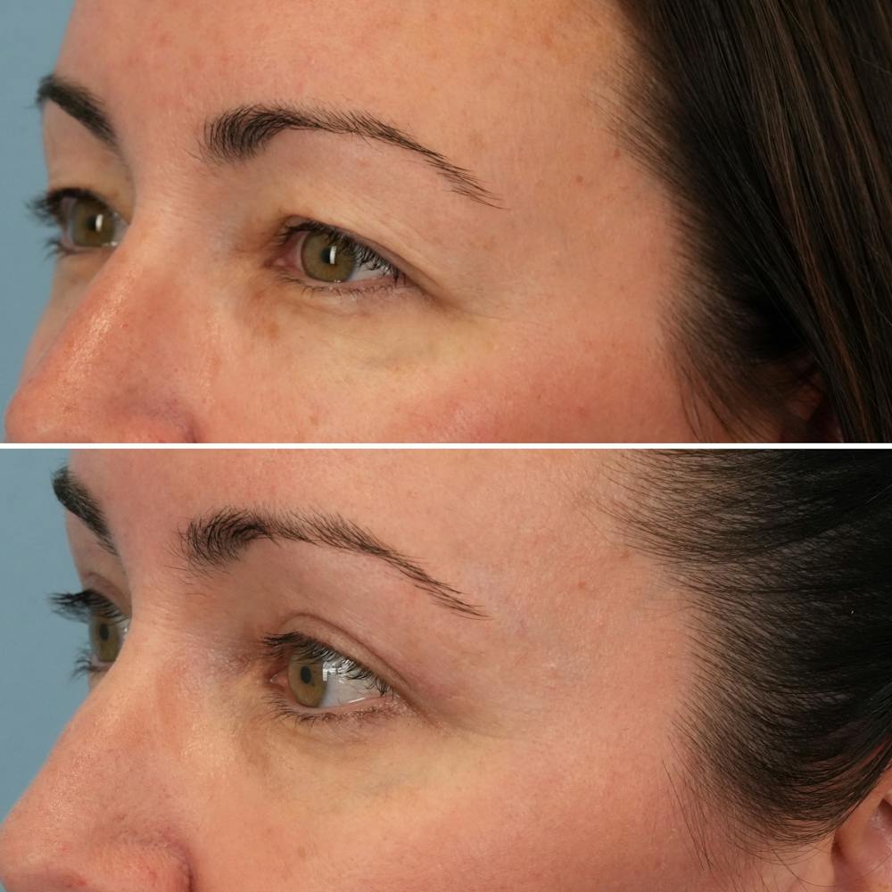 Blepharoplasty Before & After Gallery - Patient 176883565 - Image 3