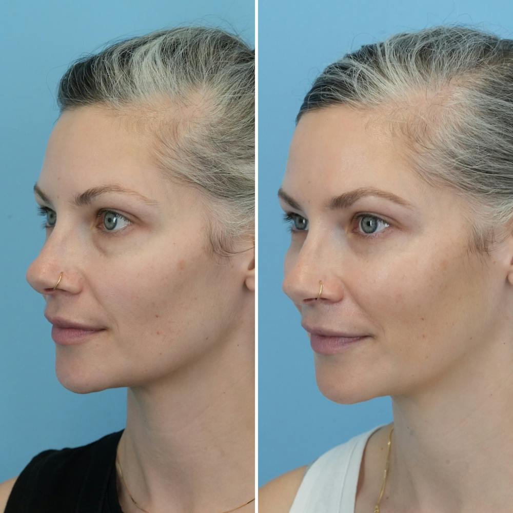 Blepharoplasty Before & After Gallery - Patient 176883545 - Image 3