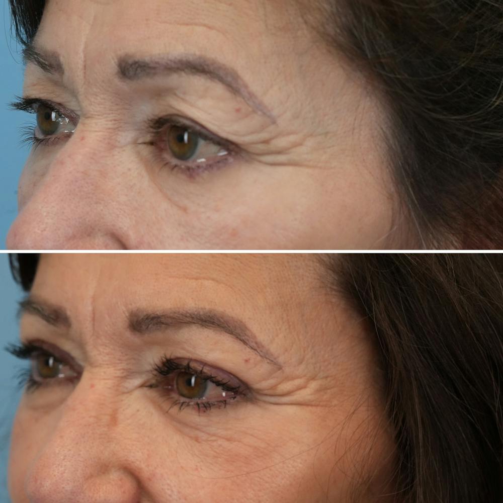 Blepharoplasty Before & After Gallery - Patient 176883567 - Image 3