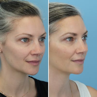 Blepharoplasty Before & After Gallery - Patient 176883545 - Image 4
