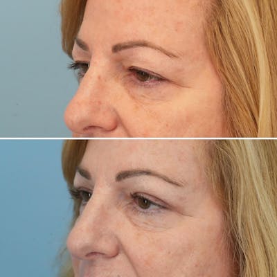 Blepharoplasty Before & After Gallery - Patient 176883566 - Image 4
