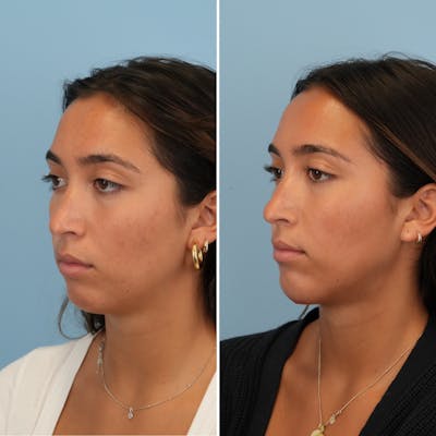 Chin Implant Before & After Gallery - Patient 176883824 - Image 4