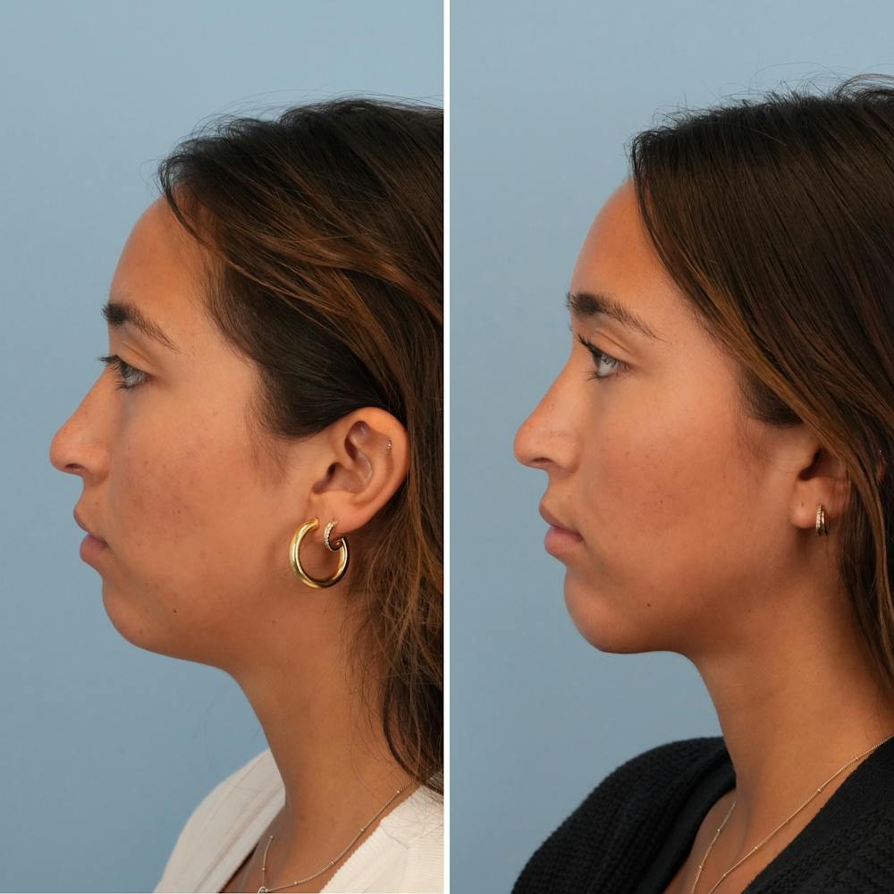 Chin Implant Before & After Gallery - Patient 176883824 - Image 5
