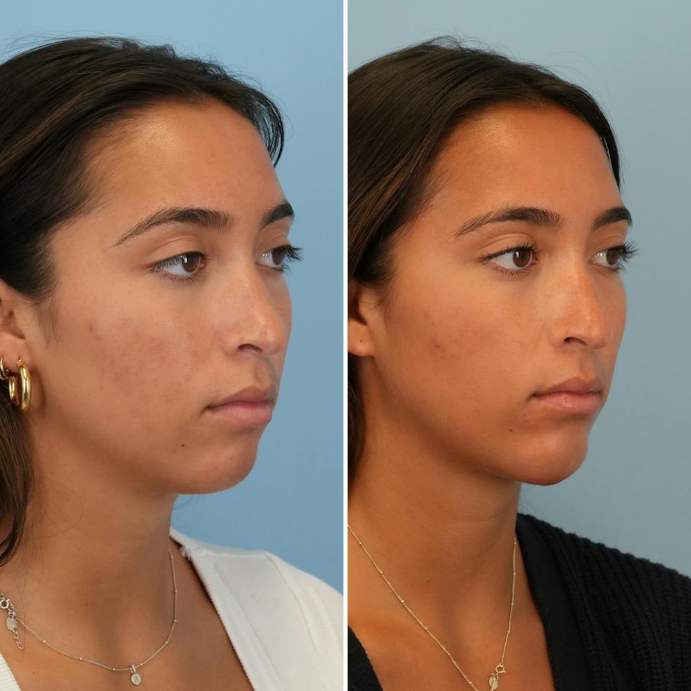 Chin Implant Before & After Gallery - Patient 176883824 - Image 2