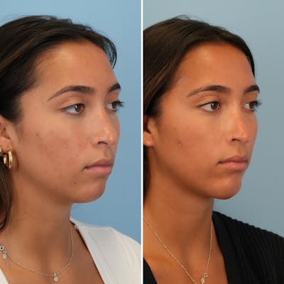 Chin Implant Before & After Gallery - Patient 176883824 - Image 2