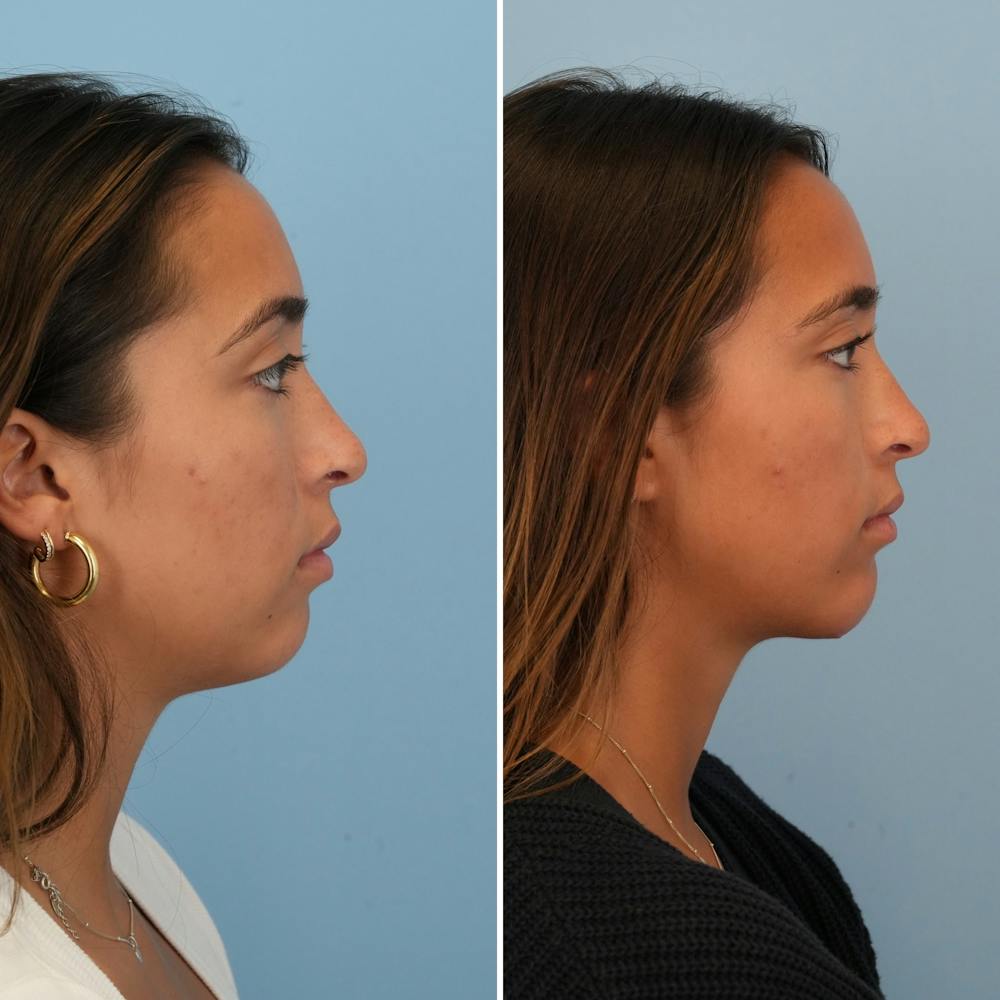 Chin Implant Before & After Gallery - Patient 176883824 - Image 3