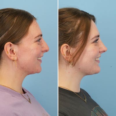Chin Implant Before & After Gallery - Patient 176883825 - Image 4