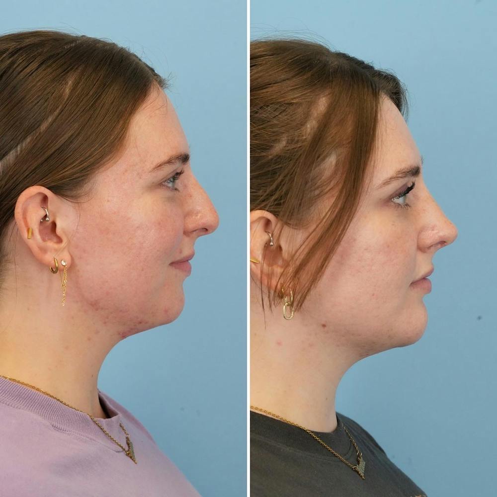 Chin Implant Before & After Gallery - Patient 176883825 - Image 3