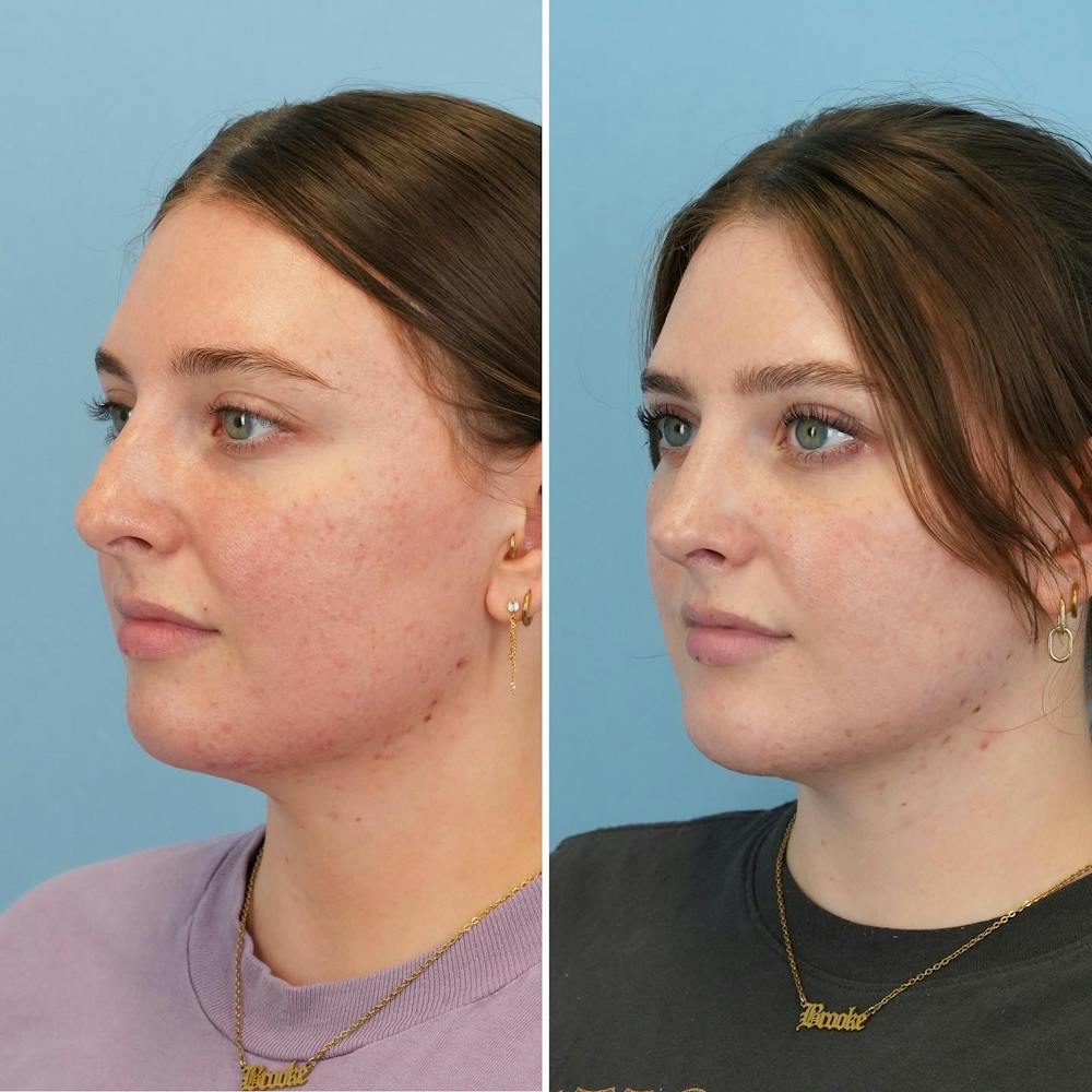 Rhinoplasty Before & After Gallery - Patient 176984345 - Image 3