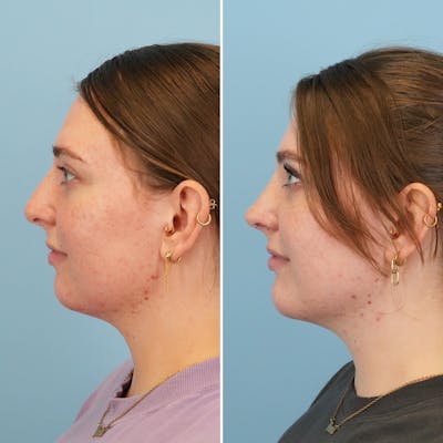 Chin Implant Before & After Gallery - Patient 176883825 - Image 6