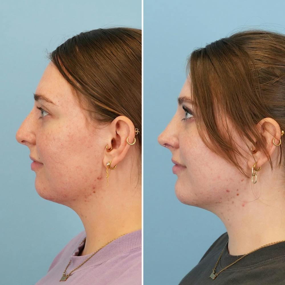 Chin Implant Before & After Gallery - Patient 176883825 - Image 6