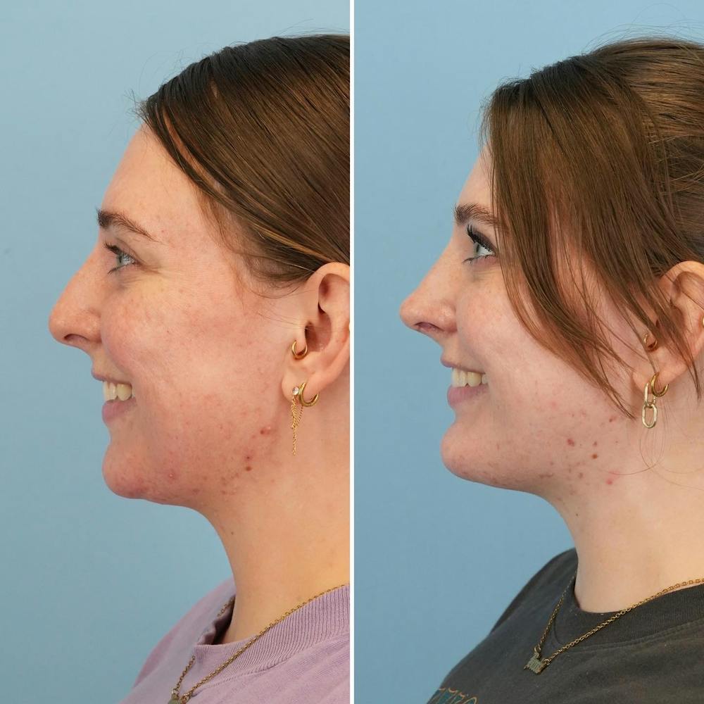 Chin Implant Before & After Gallery - Patient 176883825 - Image 7