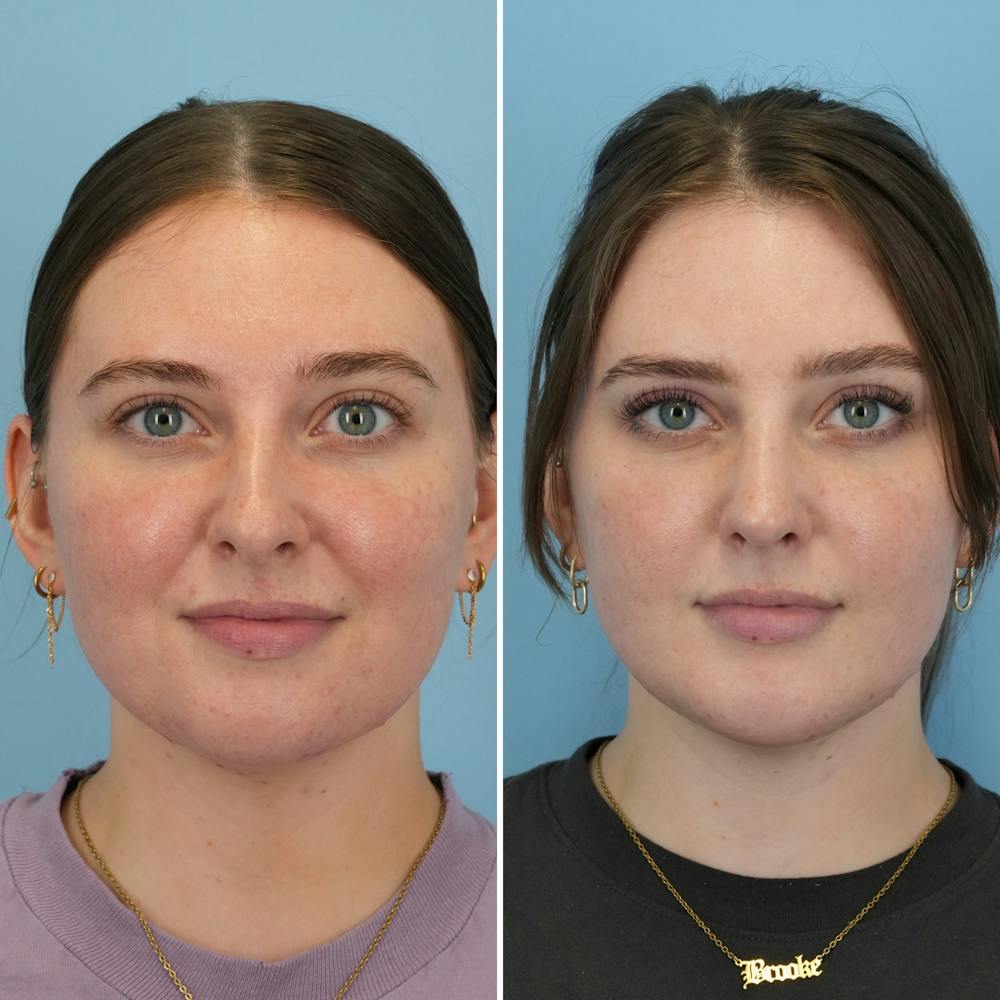 Chin Implant Before & After Gallery - Patient 176883825 - Image 1