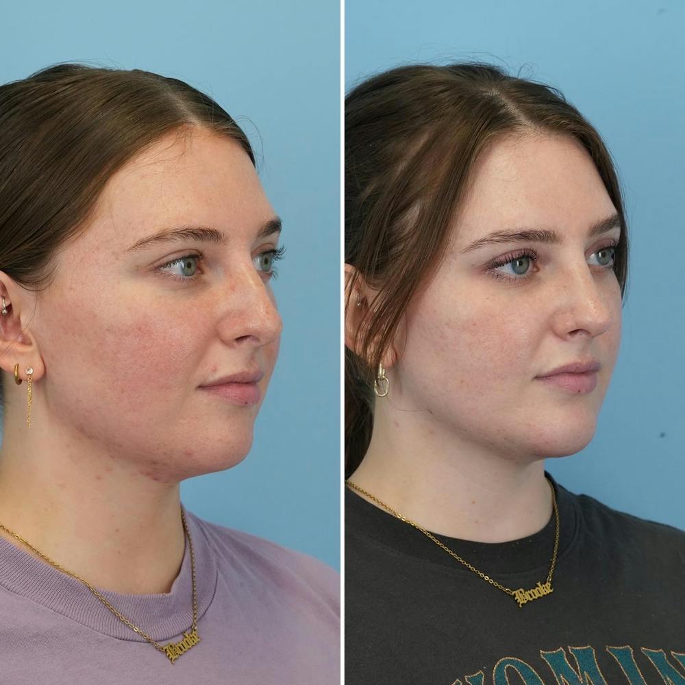Chin Implant Before & After Gallery - Patient 176883825 - Image 2